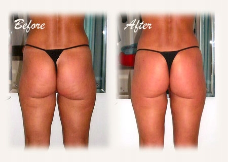 CelluSlim SILNA pianka na CELLULIT, celulit TANIO Rodzaj emulsja