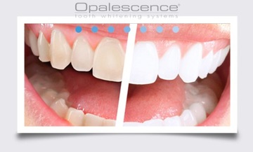 OPALESCENCE UltraEZ*1 ГЕЛЬ_ОТБЕЖИВАНИЕ ГИПЕРЧУВСТВИТЕЛЬНОСТИ