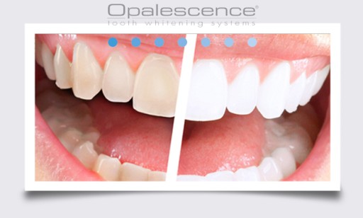 OPALESCENCE UltraEZ*1 ГЕЛЬ_ОТБЕЖИВАНИЕ ГИПЕРЧУВСТВИТЕЛЬНОСТИ